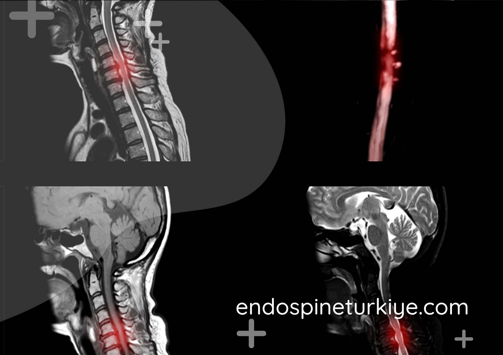 Boyun fıtığı MR görüntüsü - servikal disk hernisi